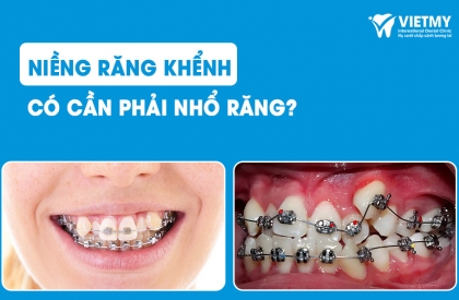 Niềng Răng Khểnh: Liệu Có Cần Phải Nhổ Răng?